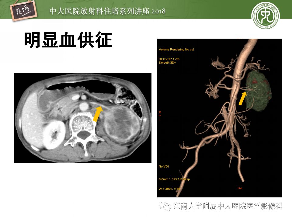 【PPT】中腹部基于器官和影像特点的鉴别诊断