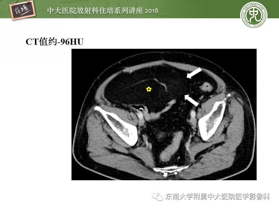 【PPT】中腹部基于器官和影像特点的鉴别诊断