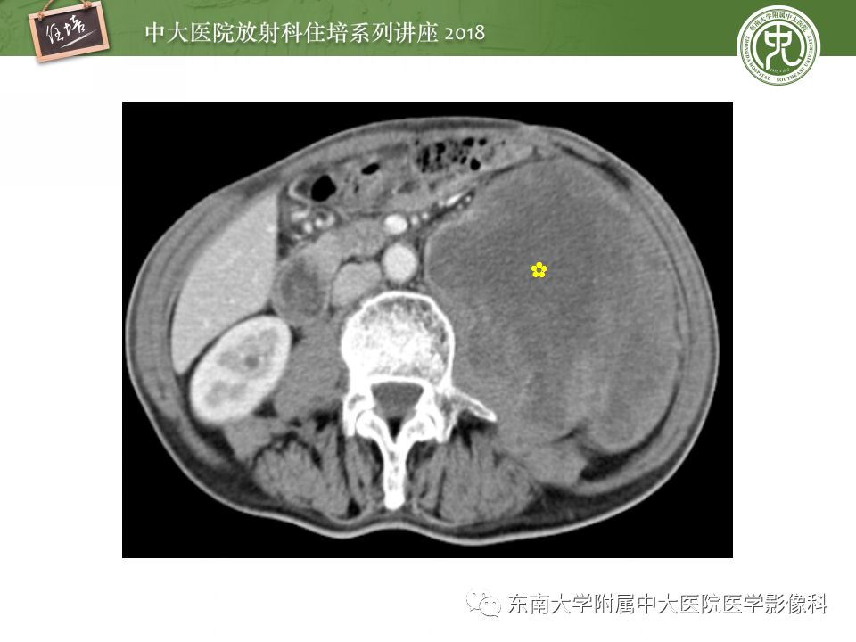 【PPT】中腹部基于器官和影像特点的鉴别诊断
