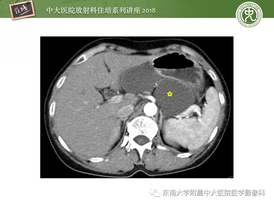 【PPT】中腹部基于器官和影像特点的鉴别诊断