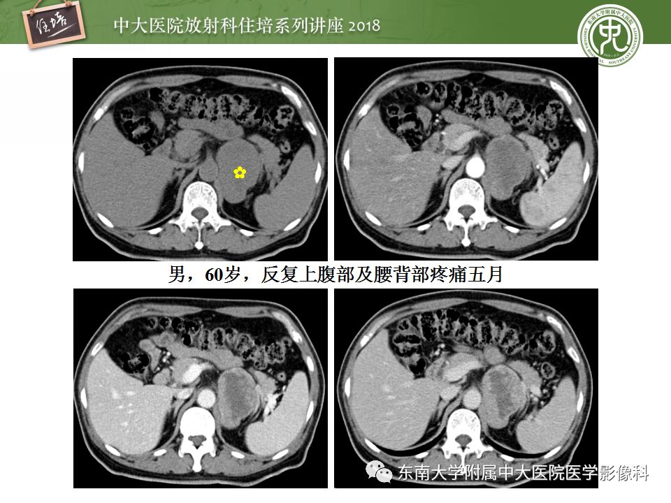 【PPT】中腹部基于器官和影像特点的鉴别诊断