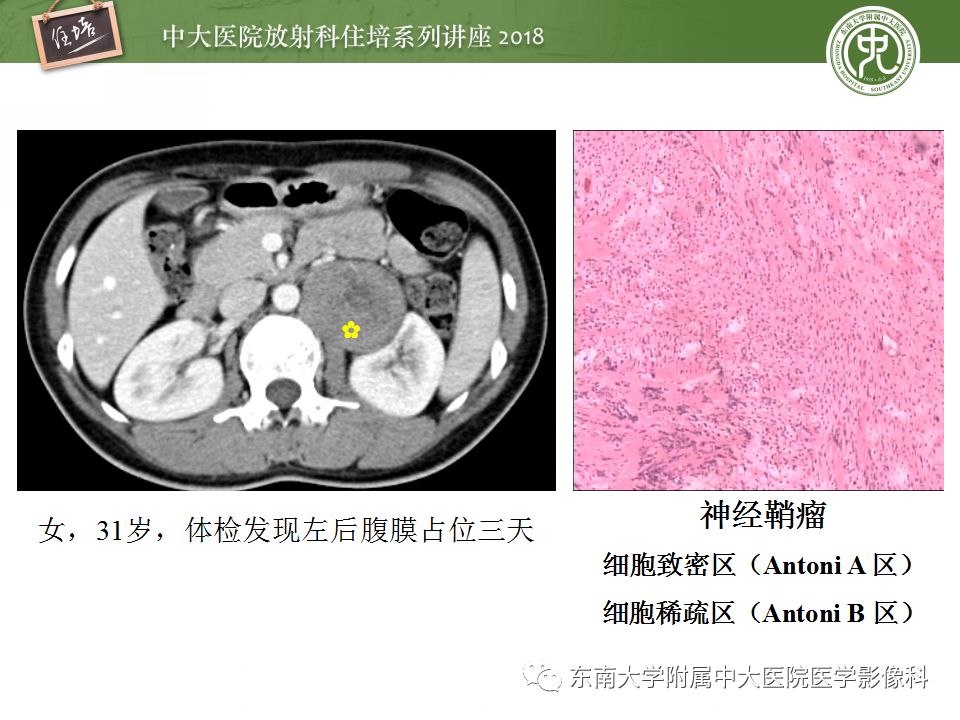 【PPT】中腹部基于器官和影像特点的鉴别诊断