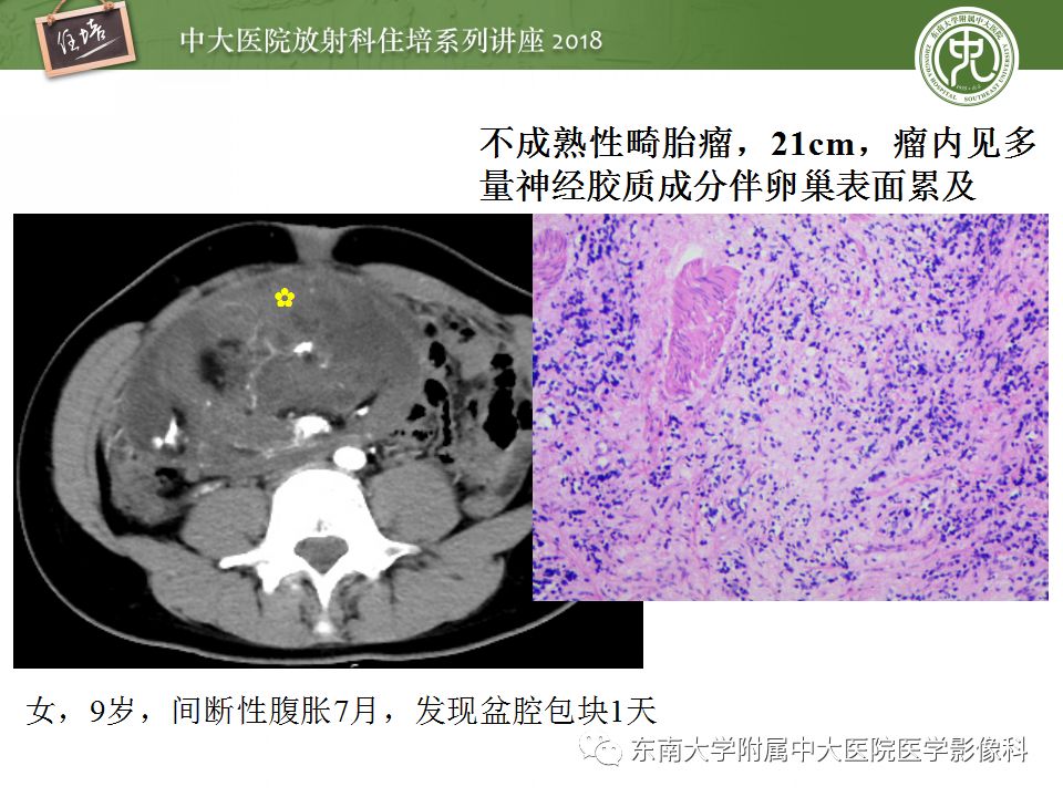 【PPT】中腹部基于器官和影像特点的鉴别诊断