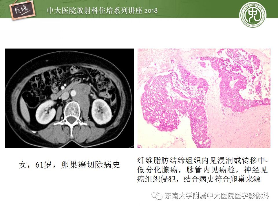 【PPT】中腹部基于器官和影像特点的鉴别诊断