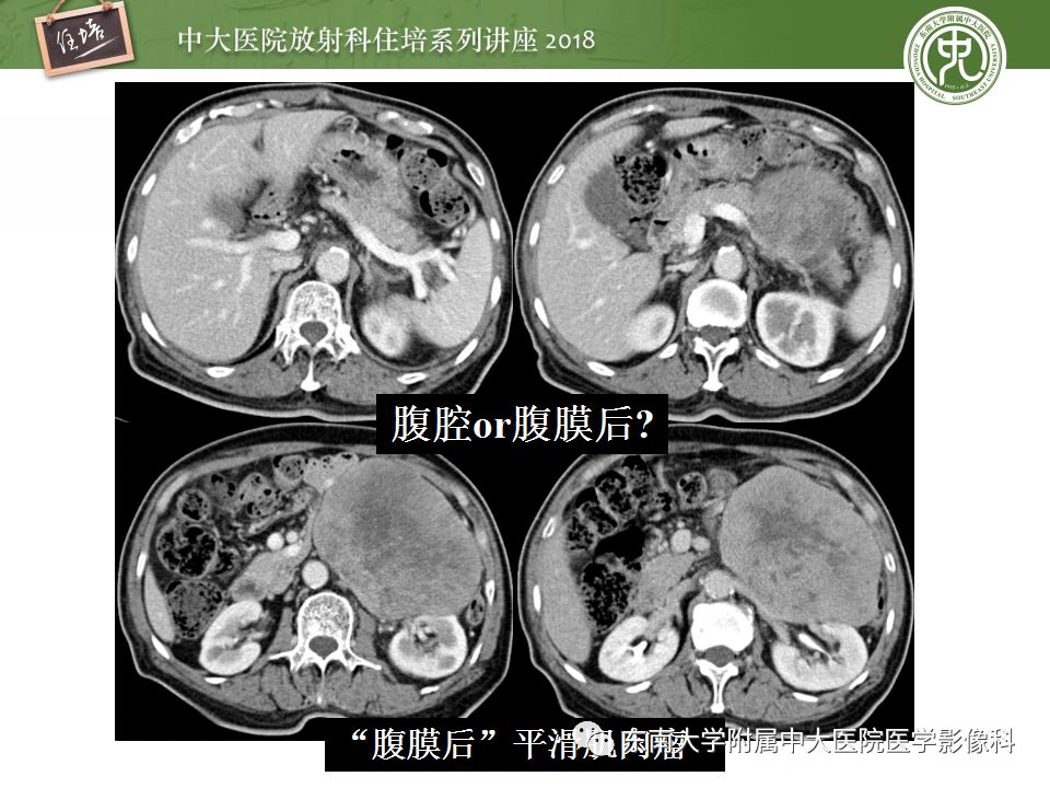 【PPT】中腹部基于器官和影像特点的鉴别诊断