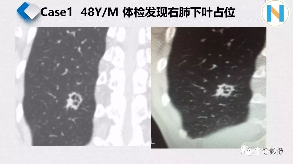 【PPT】含薄壁囊腔周围型肺癌的CT特征及病理分析 【PPT】含薄壁囊腔周围型肺癌的CT特征及病理分析