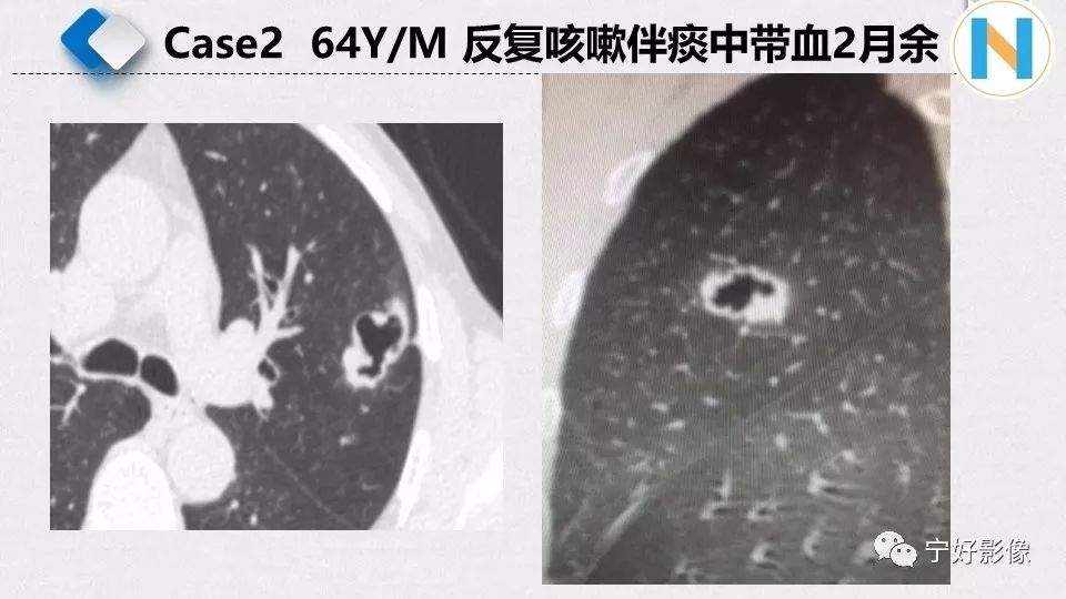 【PPT】含薄壁囊腔周围型肺癌的CT特征及病理分析 【PPT】含薄壁囊腔周围型肺癌的CT特征及病理分析