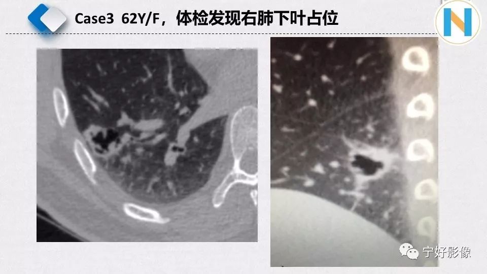 【PPT】含薄壁囊腔周围型肺癌的CT特征及病理分析 【PPT】含薄壁囊腔周围型肺癌的CT特征及病理分析