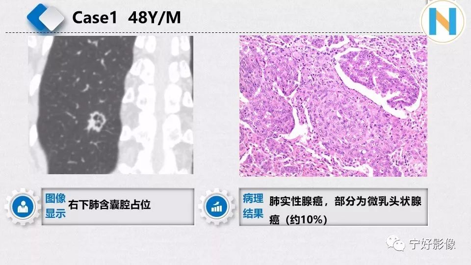 【PPT】含薄壁囊腔周围型肺癌的CT特征及病理分析 【PPT】含薄壁囊腔周围型肺癌的CT特征及病理分析