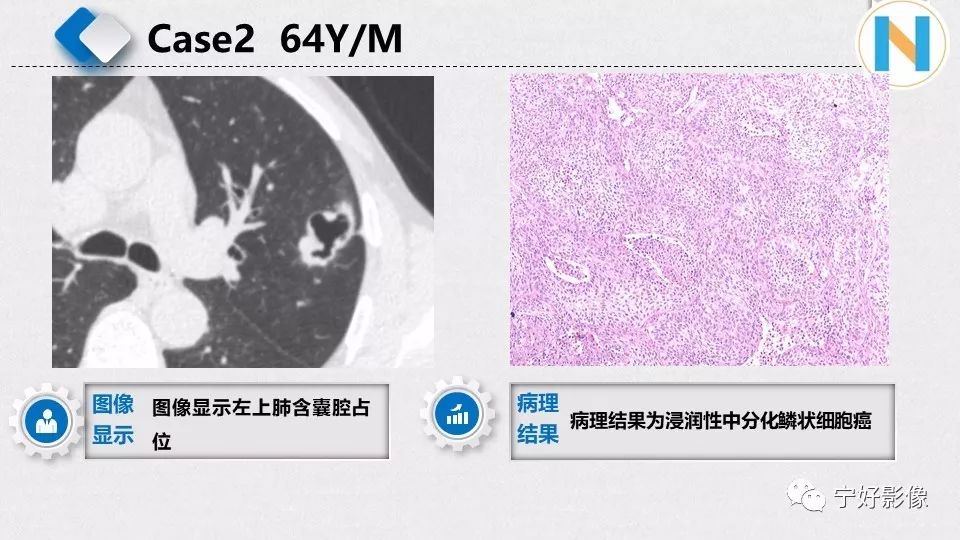 【PPT】含薄壁囊腔周围型肺癌的CT特征及病理分析 【PPT】含薄壁囊腔周围型肺癌的CT特征及病理分析