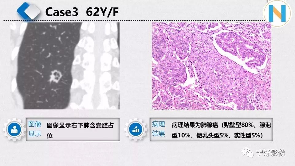【PPT】含薄壁囊腔周围型肺癌的CT特征及病理分析 【PPT】含薄壁囊腔周围型肺癌的CT特征及病理分析