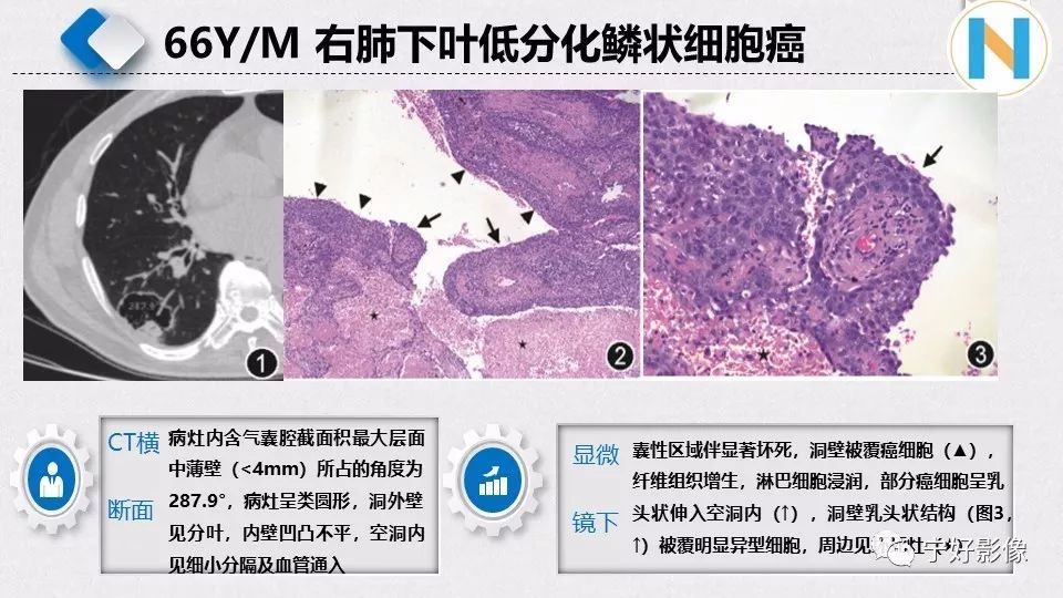 【PPT】含薄壁囊腔周围型肺癌的CT特征及病理分析 【PPT】含薄壁囊腔周围型肺癌的CT特征及病理分析