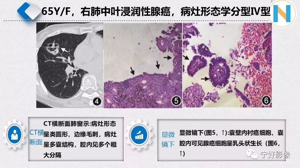 【PPT】含薄壁囊腔周围型肺癌的CT特征及病理分析 【PPT】含薄壁囊腔周围型肺癌的CT特征及病理分析