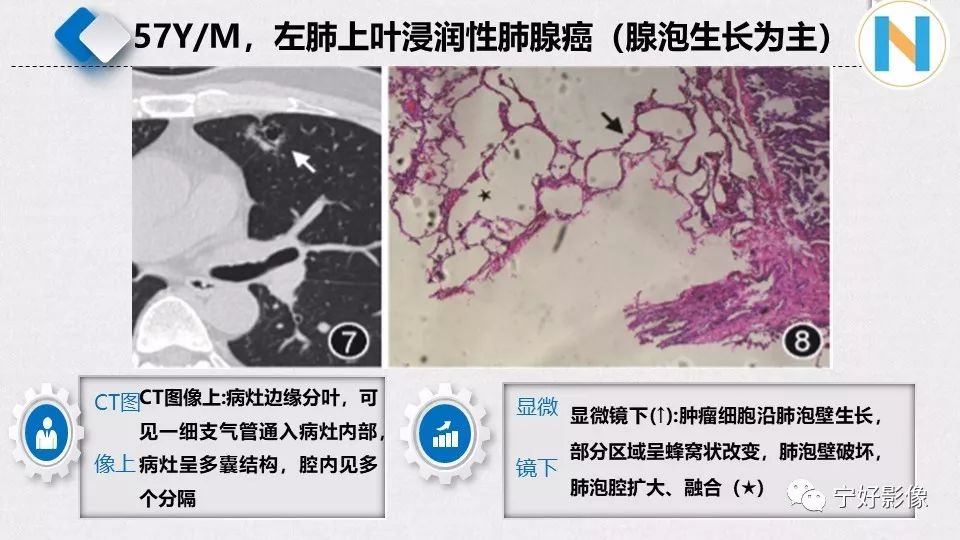 【PPT】含薄壁囊腔周围型肺癌的CT特征及病理分析 【PPT】含薄壁囊腔周围型肺癌的CT特征及病理分析