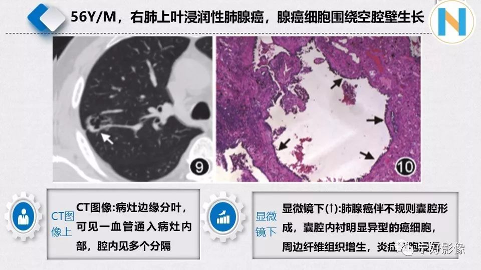 【PPT】含薄壁囊腔周围型肺癌的CT特征及病理分析 【PPT】含薄壁囊腔周围型肺癌的CT特征及病理分析