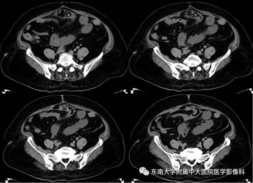 【病例】消化道及呼吸道异物4例CT