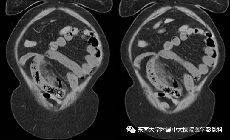 【病例】消化道及呼吸道异物4例CT