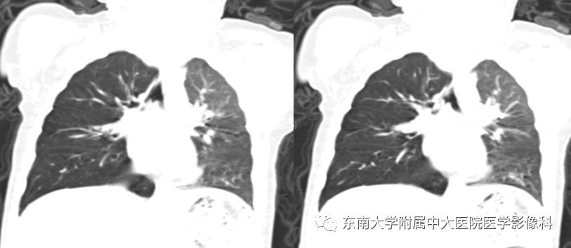 【病例】消化道及呼吸道异物4例CT