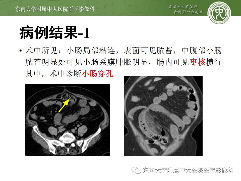 【病例】消化道及呼吸道异物4例CT