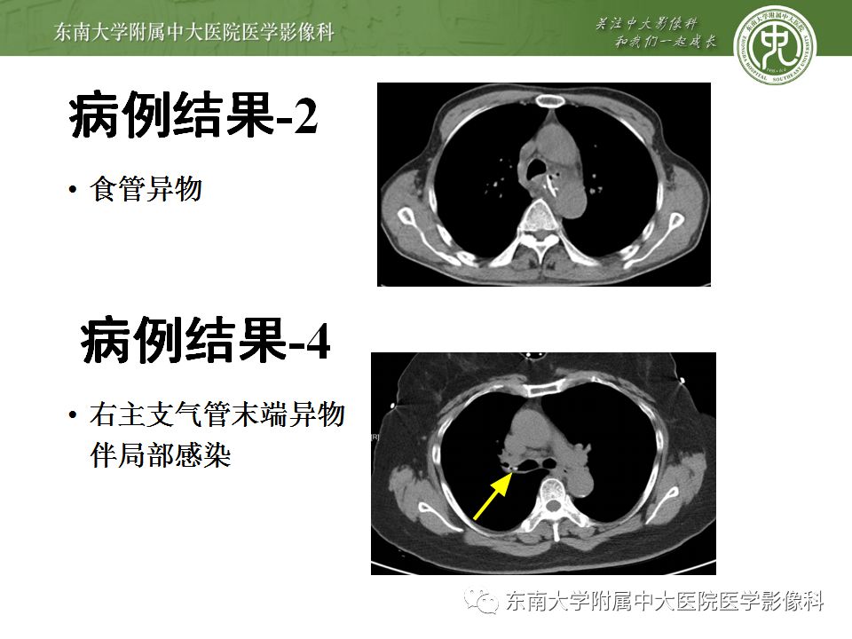 【病例】消化道及呼吸道异物4例CT