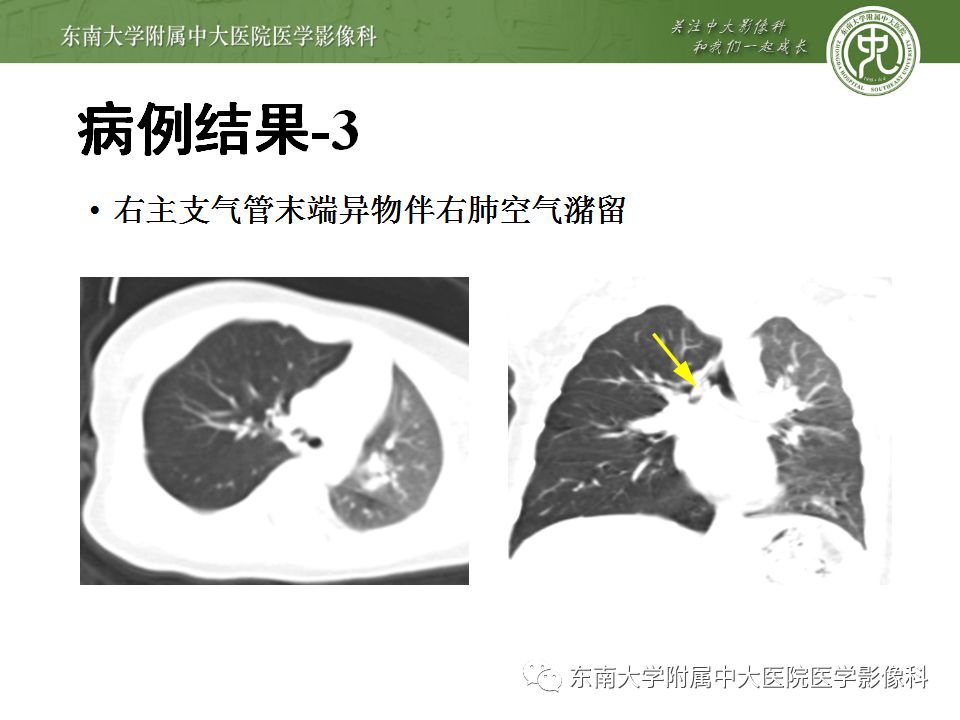 【病例】消化道及呼吸道异物4例CT