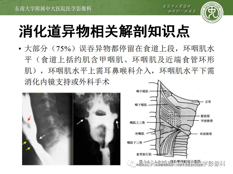 【病例】消化道及呼吸道异物4例CT