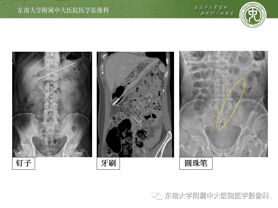 【病例】消化道及呼吸道异物4例CT
