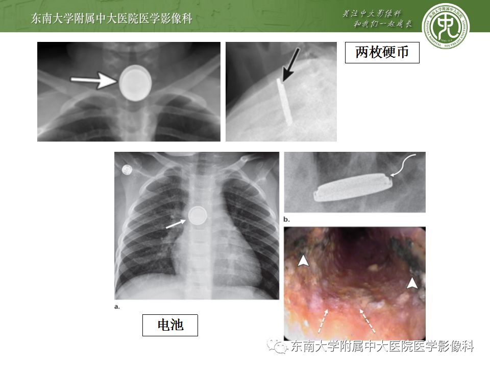 【病例】消化道及呼吸道异物4例CT