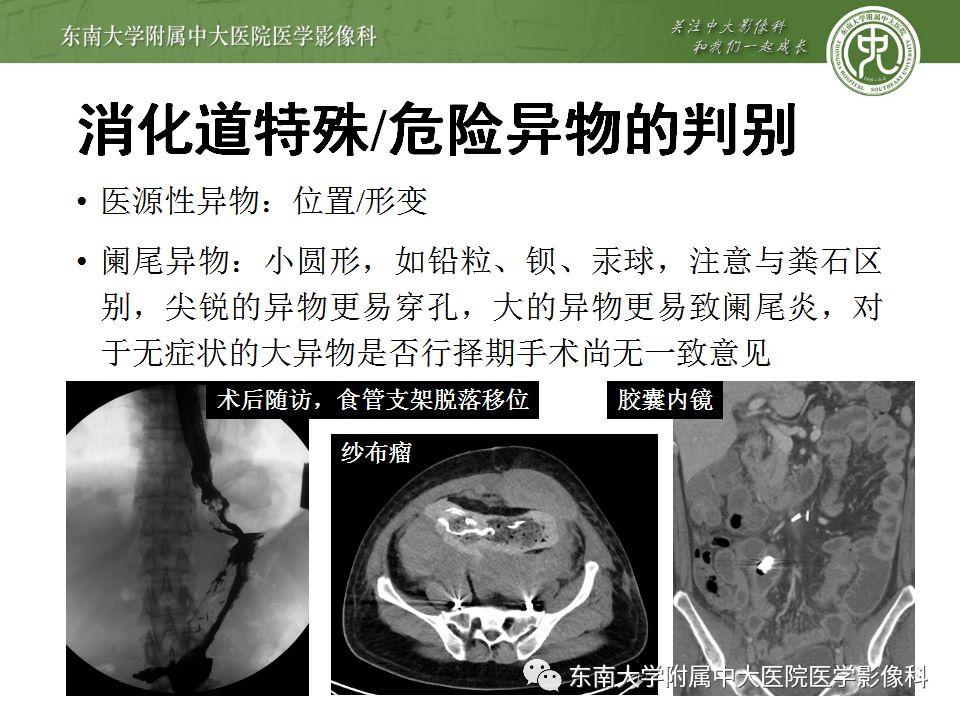【病例】消化道及呼吸道异物4例CT