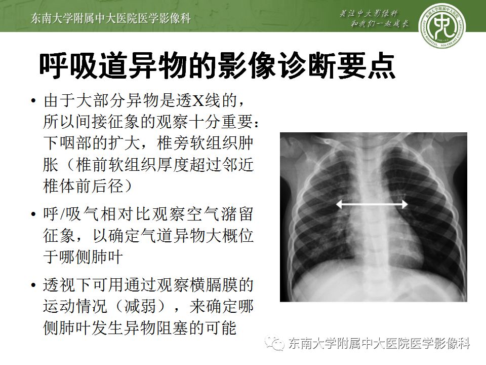 【病例】消化道及呼吸道异物4例CT