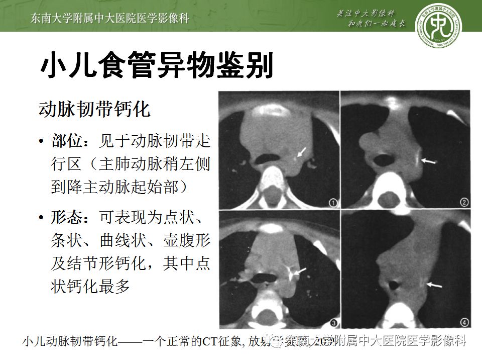【病例】消化道及呼吸道异物4例CT