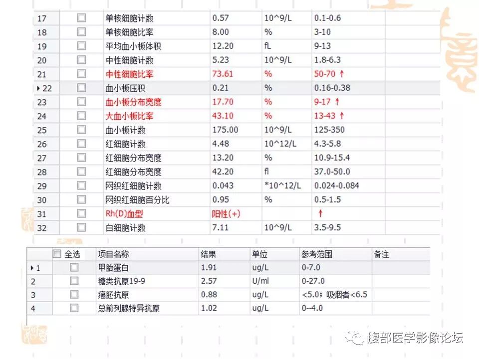 【病例】胆囊癌1例CT及MR影像表现
