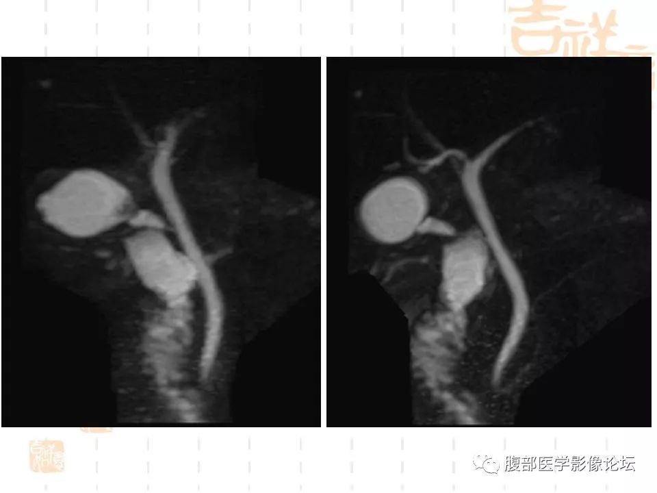 【病例】胆囊癌1例CT及MR影像表现