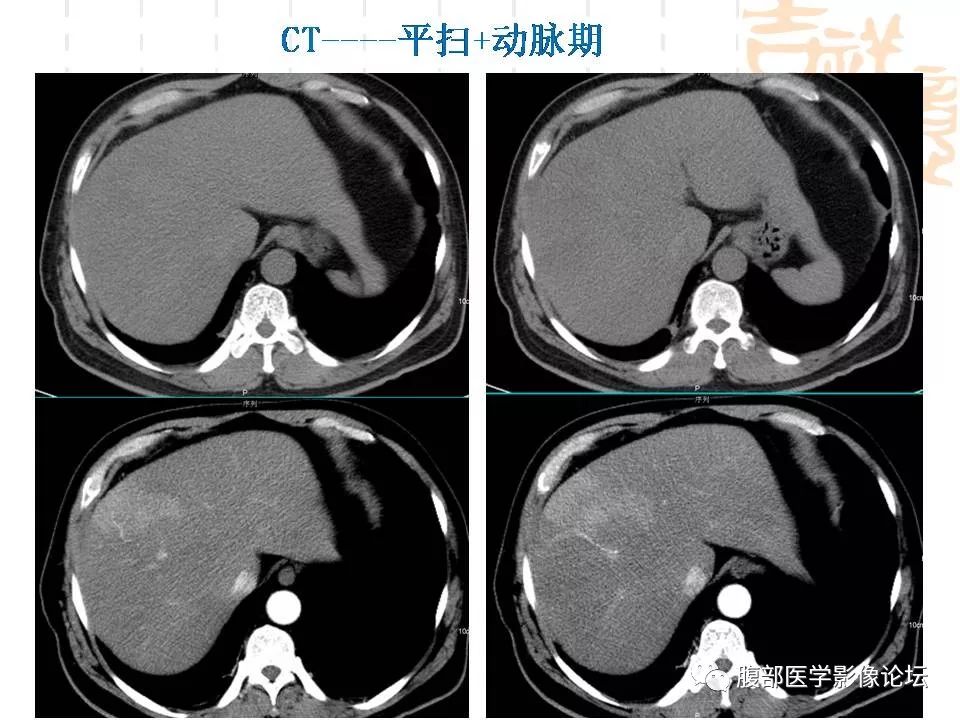 【病例】胆囊癌1例CT及MR影像表现