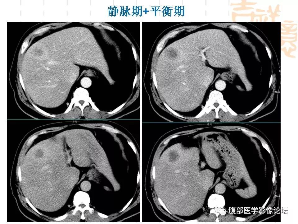 【病例】胆囊癌1例CT及MR影像表现