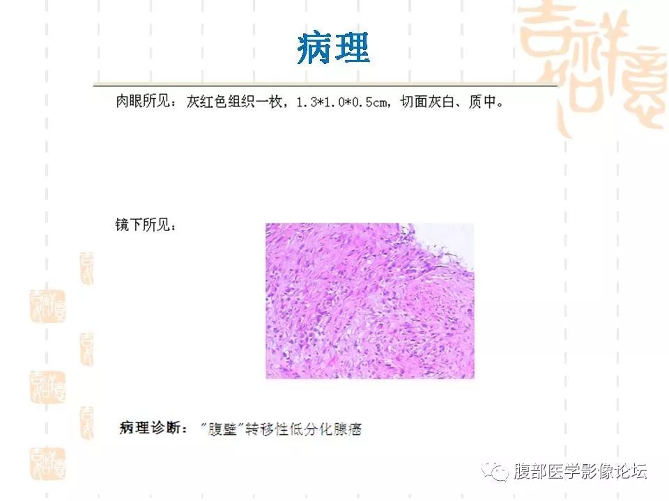 【病例】胆囊癌1例CT及MR影像表现