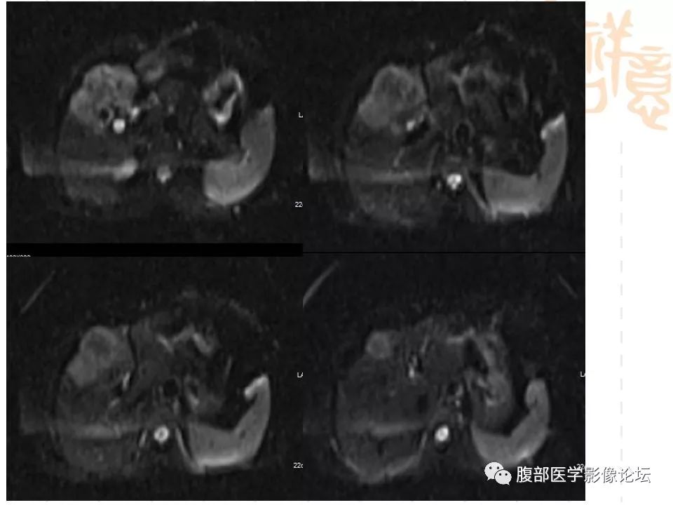 【病例】胆囊癌1例CT及MR影像表现
