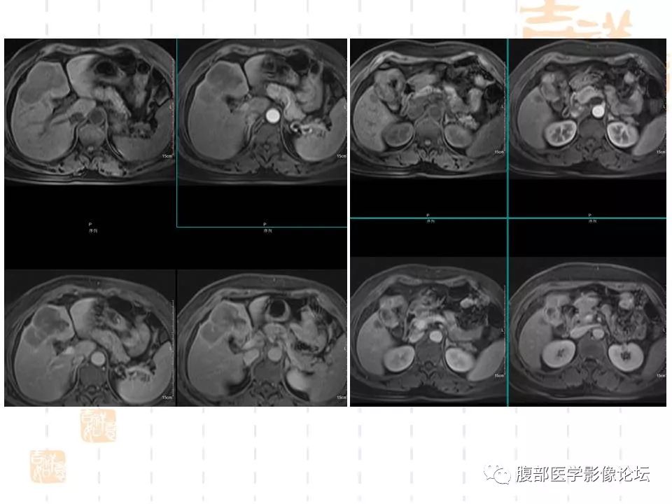 【病例】胆囊癌1例CT及MR影像表现