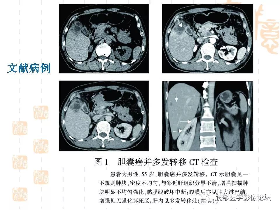 【病例】胆囊癌1例CT及MR影像表现