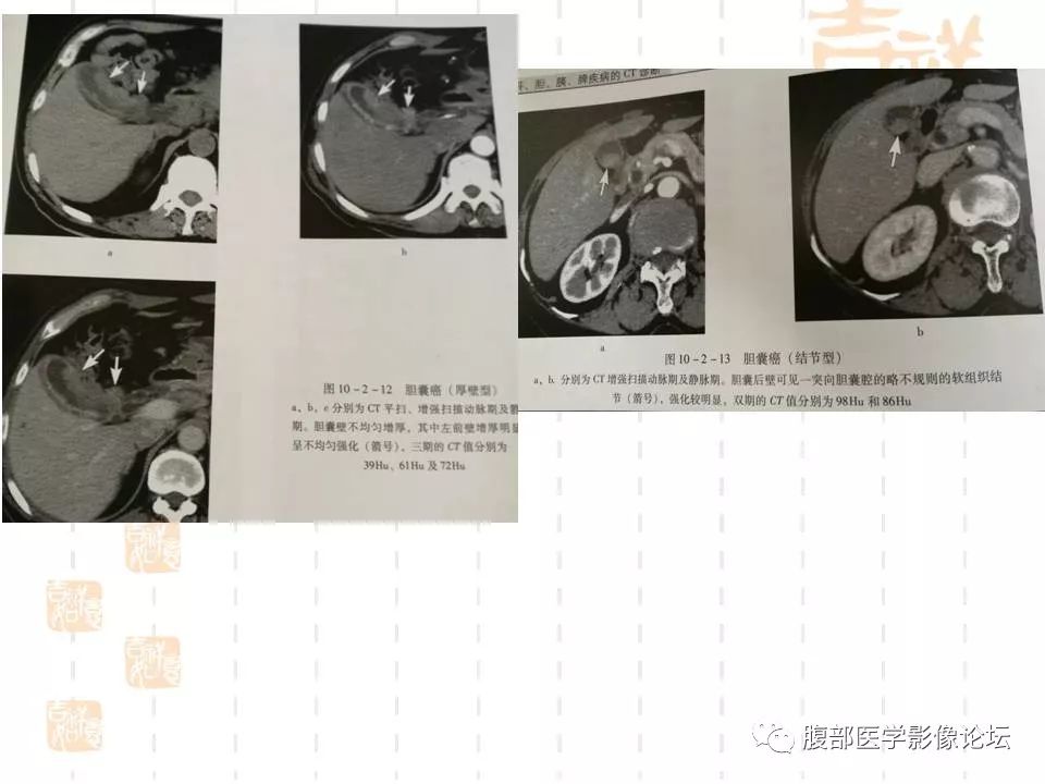 【病例】胆囊癌1例CT及MR影像表现