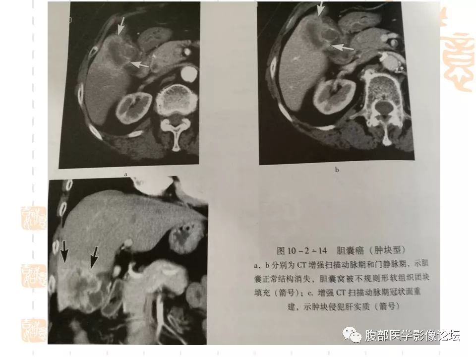 【病例】胆囊癌1例CT及MR影像表现