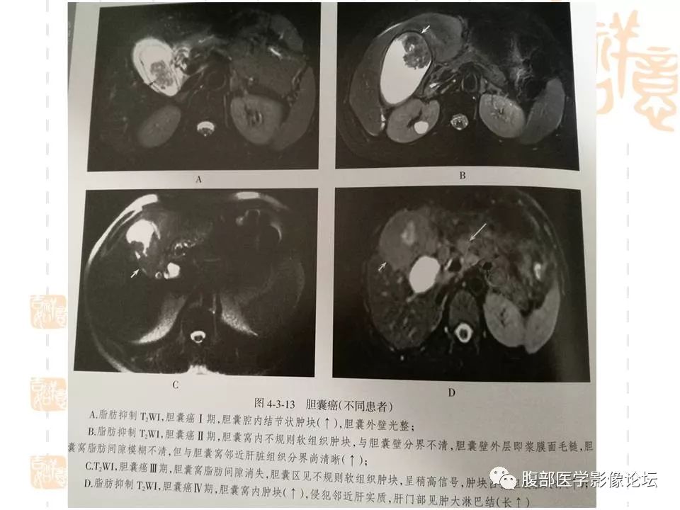 【病例】胆囊癌1例CT及MR影像表现