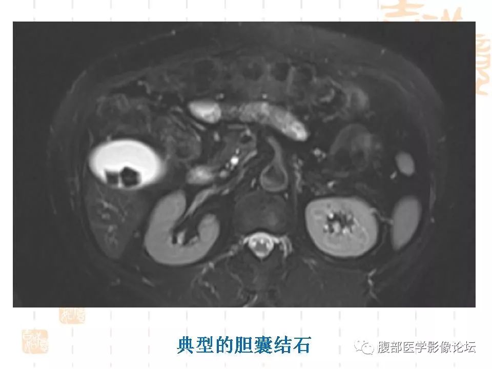【病例】胆囊癌1例CT及MR影像表现
