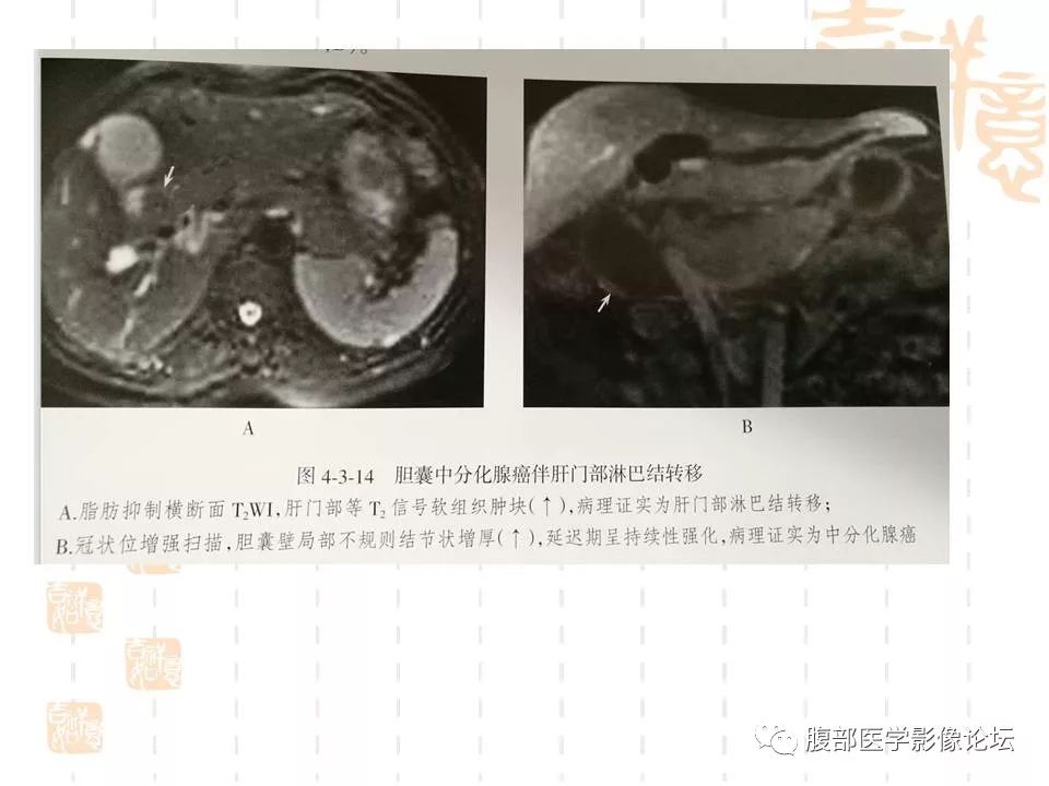 【病例】胆囊癌1例CT及MR影像表现