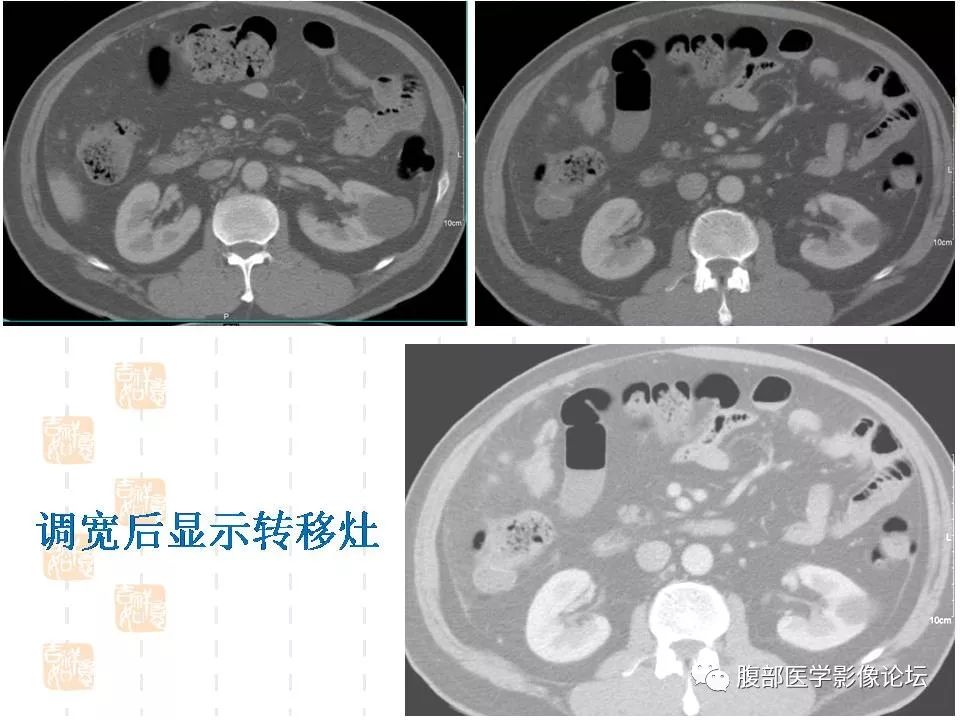 【病例】胆囊癌1例CT及MR影像表现