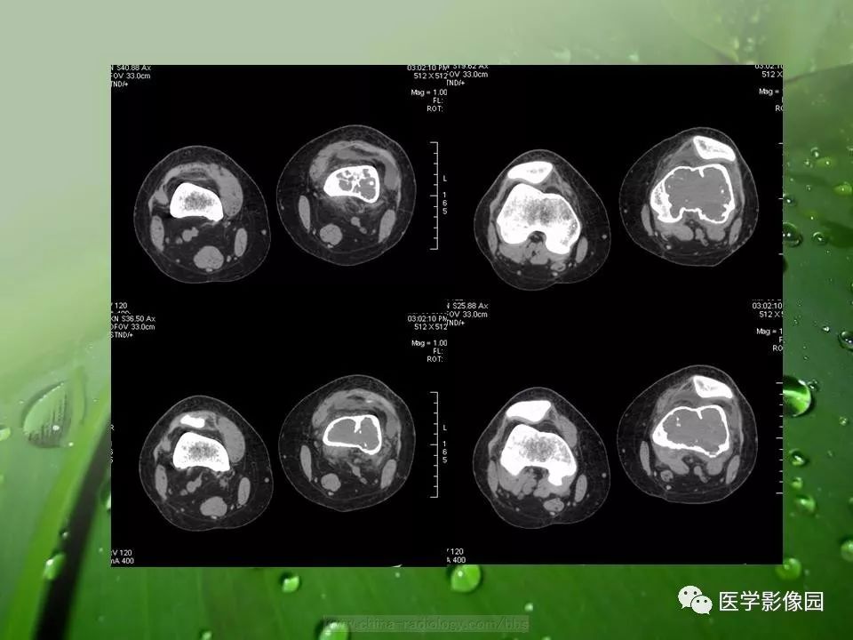 【病例】骨巨细胞瘤1例CT及MR影像表现