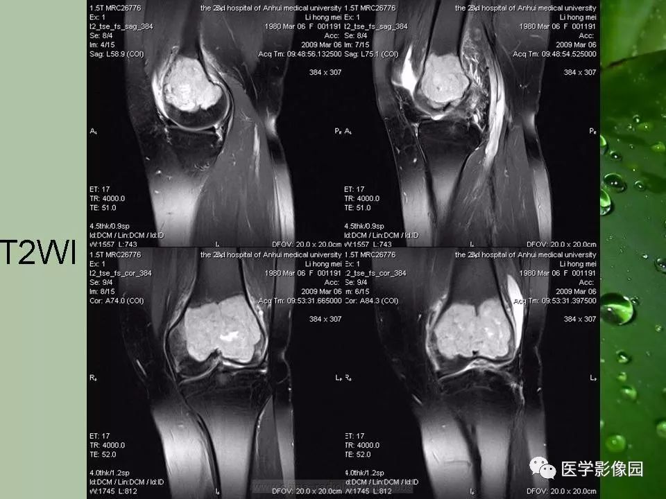【病例】骨巨细胞瘤1例CT及MR影像表现