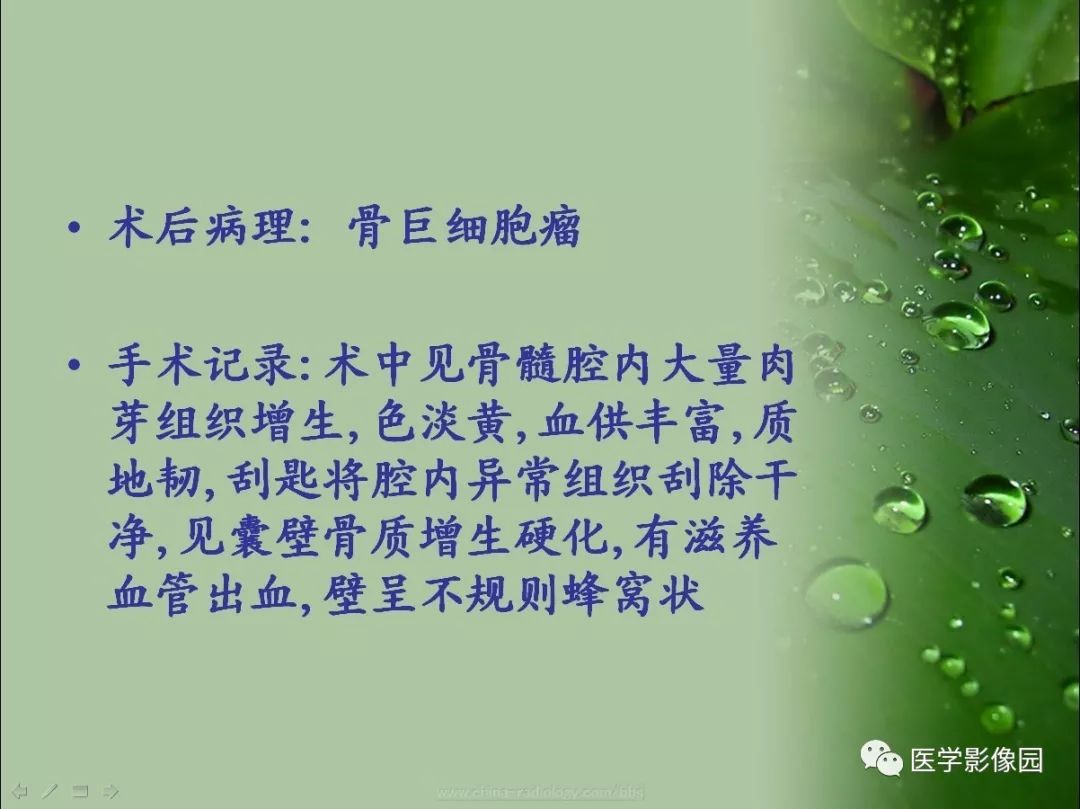 【病例】骨巨细胞瘤1例CT及MR影像表现