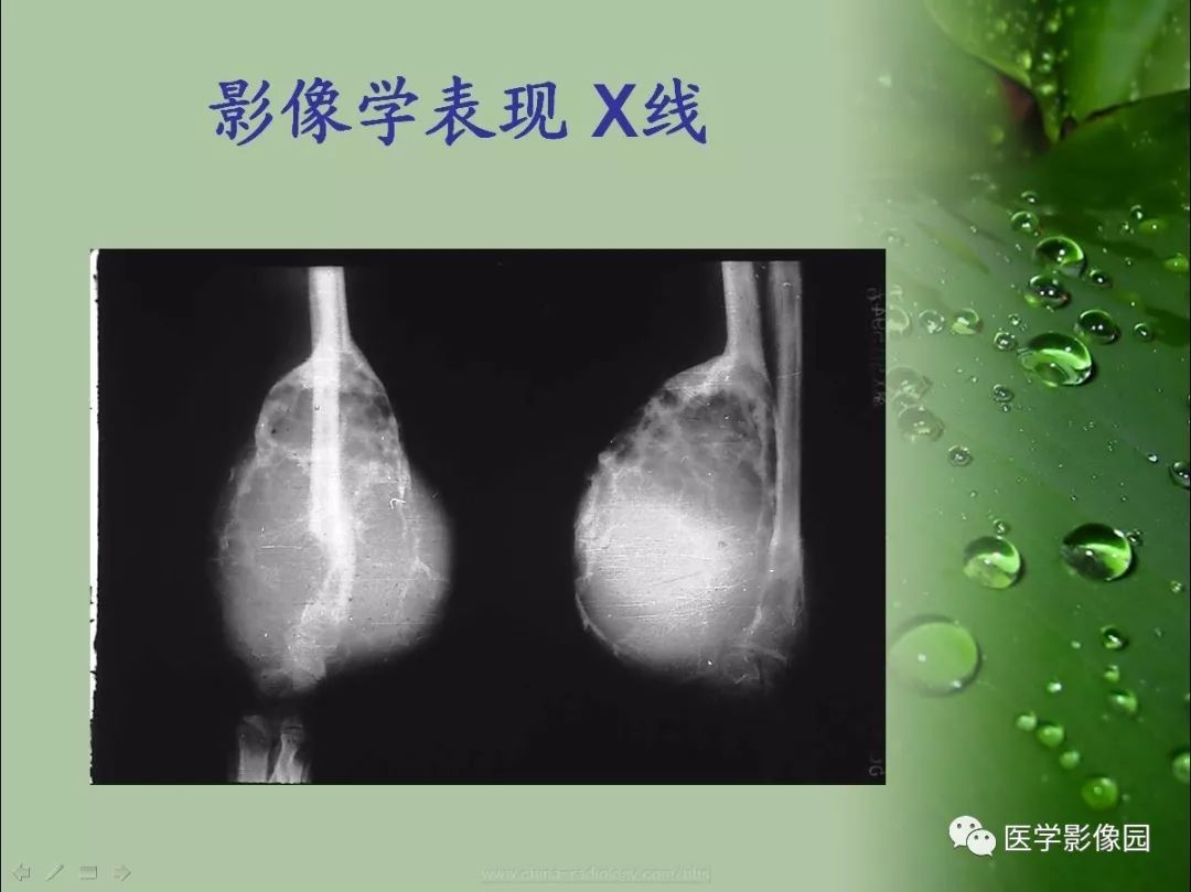 【病例】骨巨细胞瘤1例CT及MR影像表现