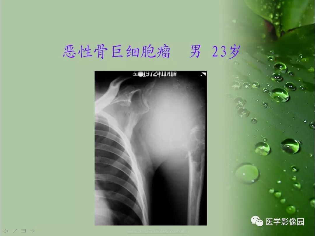 【病例】骨巨细胞瘤1例CT及MR影像表现